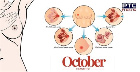As the cancer progresses, signs and symptoms can include a lump or thickening in or near the breast; Common signs and symptoms of Breast Cancer in October
