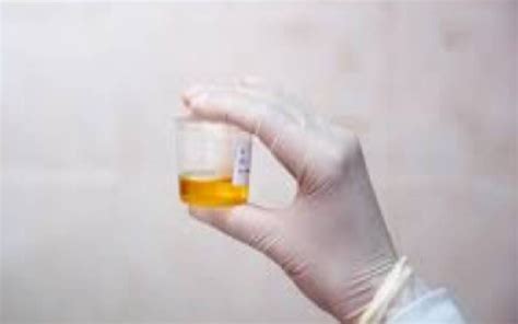 Simple Urine Test Can Now Diagnose One Of The Deadliest Cancers In Early Stages The Standard