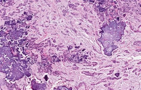 Pathology Outlines Calcifying Epithelial Odontogenic Tumor