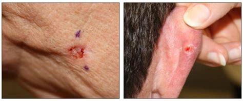 Ulcerated Basal Cell Carcinoma Dr Monica Scheel Dermatology