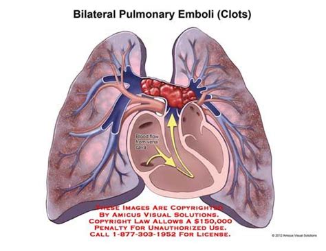 Pulmonary Emboli Pulmonary Pulmonary Embolism