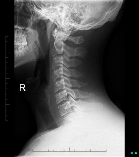 Álbumes 93 Foto Rx De Columna Lumbosacra Ap Y Lateral Alta Definición