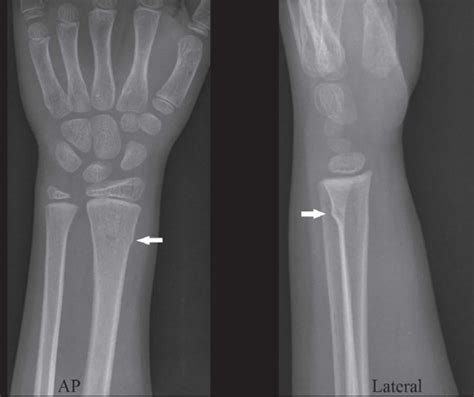 Buckle Fracture Causes Symptoms Diagnosis And Treatment