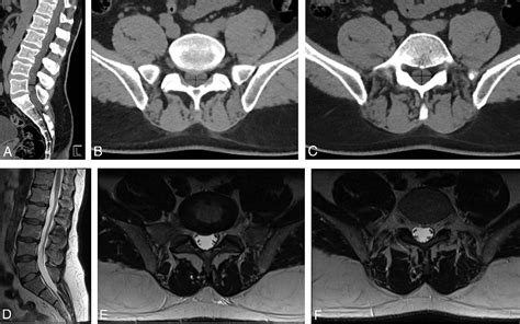 Figure 1 From Of Ct In Suspected Cauda Equina Syndrome Doing More With