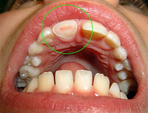 Classification of pulpitis: their types and forms ...