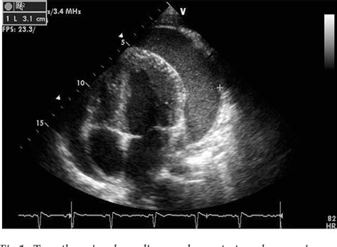 Figure 1 From Primary Pericardial Mesothelioma In A 19 Year Old