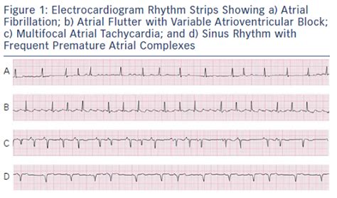 Figure 1 Electrocardiogram Rhythm Strips Showing A Atrial