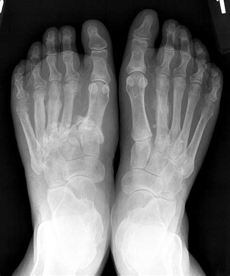Differential Diagnosis Of Charcot Arthropathy Lower Extremity Review