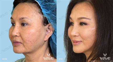 Facelifts In Los Angeles Wave Plastic Surgery