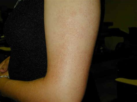 Rough Skin On Arms Dorothee Padraig South West Skin Health Care