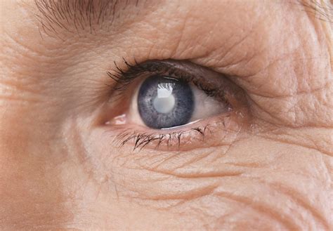 What Is Glaucoma Eye Disease And How Can We Treat It