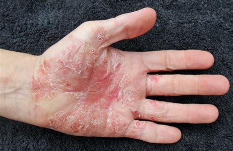 Dry Skin Patches Causes Symptoms Diagnosis And Treatments