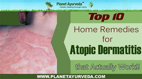 top 10 home remedies for atopic dermatitis eczema that actually work youtube