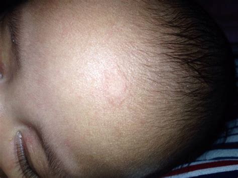 Cyst On Babys Forehead Photo Included Babycenter