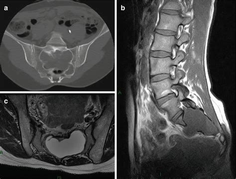 Imaging Of Sacral Tumors Experience Of The Rizzoli Institute