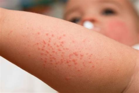 Alergia em bebê como identificar e tratar