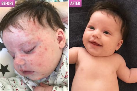 Mum Whose Baby Girls Eczema Was So Severe She Thought It Was