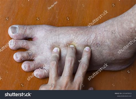 Pitting Edema Lower Limb Swollen Foot Stock Photo 2153479313 Shutterstock