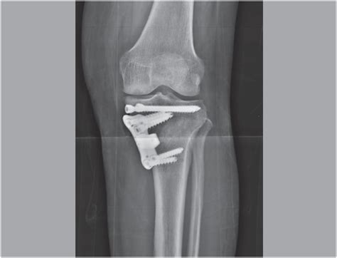 Scielo Brasil High Tibial Osteotomy Using A Locking Titanium Plate