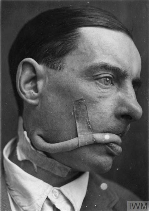 The Work Of Major Harold Gillies In The Field Of Plastic Surgery During