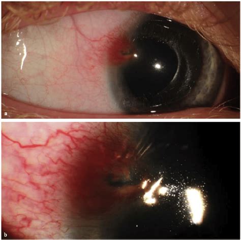 A Slit Lamp Photograph Showing Corneal Lesion With Surrounding