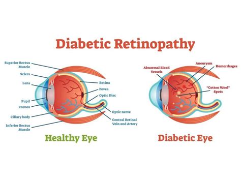 Diabetic Retinopathy Symptoms Causes Stages Treatment And More