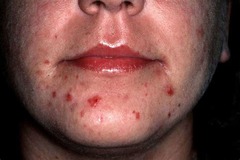 Acne Excoriee Pictures Photos
