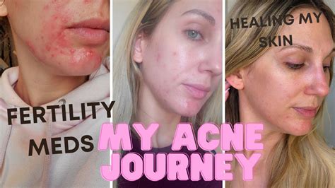 How I Cleared My Acne Fertility Meds Hormonal Changes More Youtube