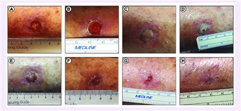 Progression Of Mohs Shin Wound Healing After Mvasc Treatment A Upon