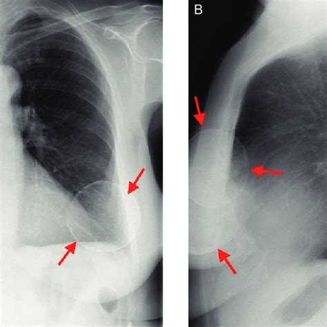 Standard Chest Radiograph Taken In A Posterior Anterior And B