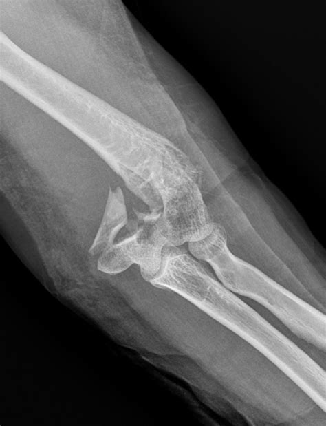 Distal Humerus Intercondylar Fractureorif