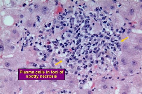 Title Slide Autoimmune Liver Disease Definition Psc Primary