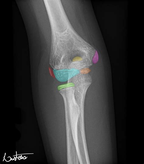 Elbow Ossification Centers Image Radiopaedia Org