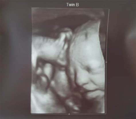 30 Weeks Pregnant With Twins Tips Advice And How To Prep Twiniversity
