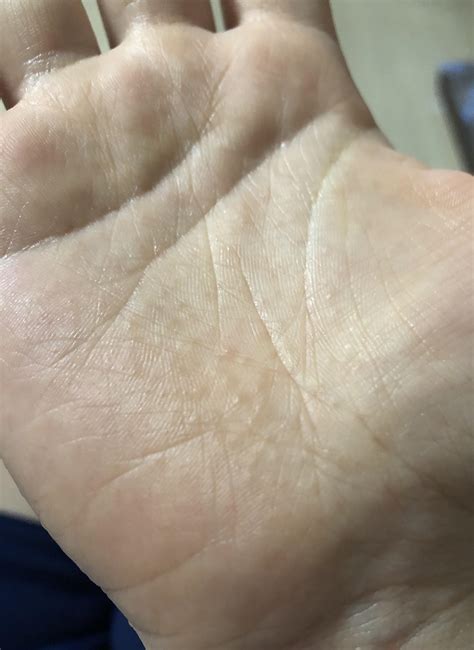 Is This Dyshidrosis Suddenly Got These Itchy Little Blisters On My