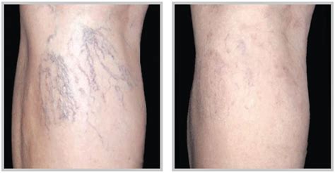 Spider Vein Removal Facial And Leg Veins Laser Creations