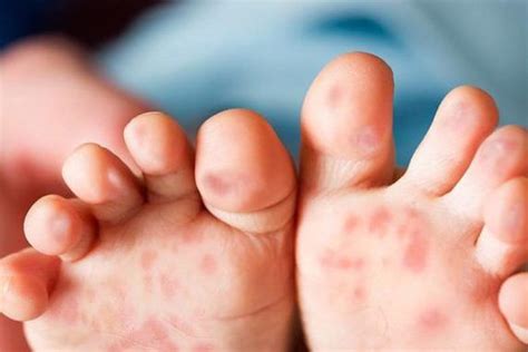 Signs You Or Your Child May Be Suffering From Hand Foot And Mouth