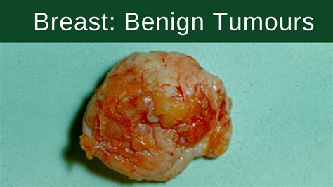 Breast Benign Tumours Pathology Mini Tutorial Youtube