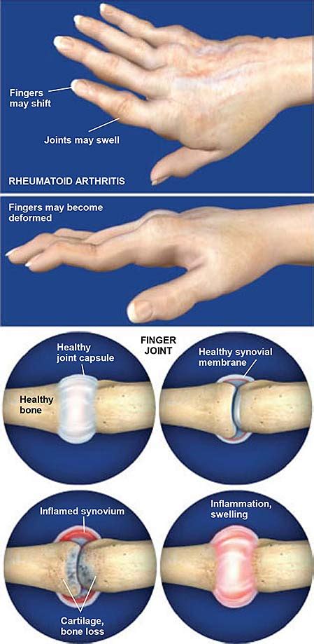 Rheumatoid Arthritis Ra Of The Hand Central Coast Orthopedic