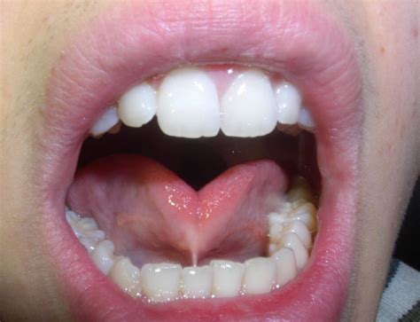What Does A Tongue Tie Look Like Dr Chelsea Pinto Los Angeles