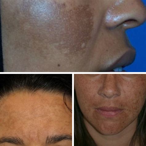 What Is Melasma How Can You Treat Melasma Geelong Veins Skin And Laser