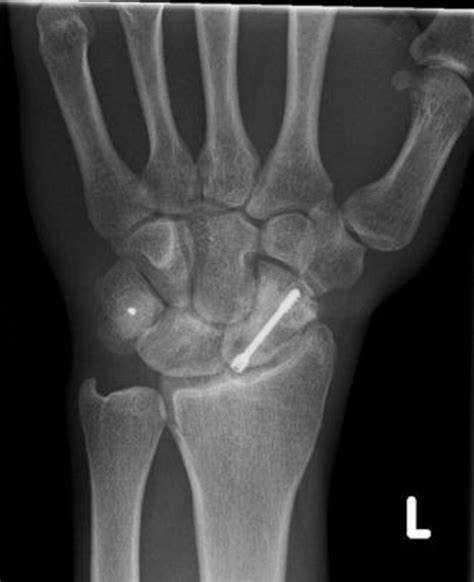 Wrist Pa X Ray At 20 Months Suggesting Scaphoid Fracture