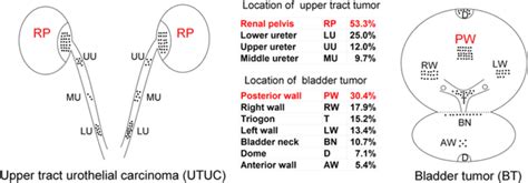 Location Of Panucc In Upper Tract And Bladder Note The Number Of