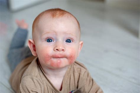 Sarpullido En BebÉs 16 Tipos Causas Y Tratamiento