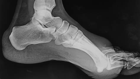 Unusual Presentation Of Foreign Body Granuloma Of The Foot After Sharp