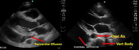 Pericardial Vs Pleural Effusion — Temple Point Of Care Ultrasound