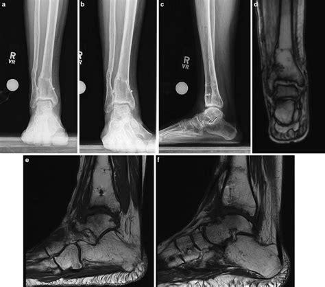 52 Ankle Distraction And Supramalleolar Osteotomy For Arthrosis And