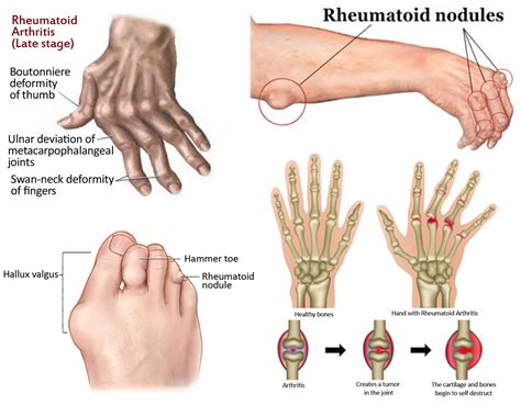 How To Manage A Thumb Deformity From Rheumatoid Arthritis Atelier Yuwaciaojp