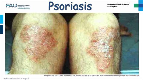 Dermatologie ─ Psoriasis Youtube