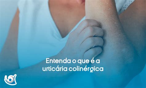 Urticária colinérgica causas sintomas e tratamento Alergoclínica
